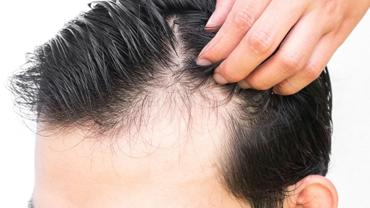 علت ریزش ناگهانی موی سر چیست؟ + فیلم