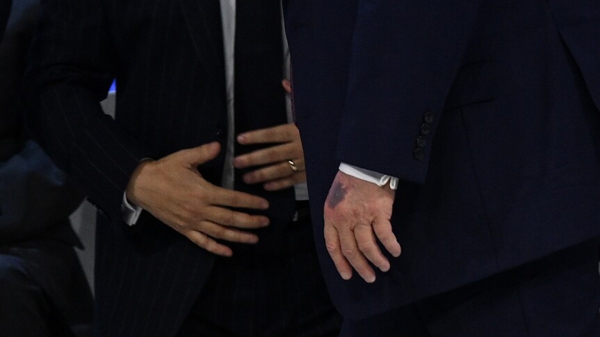 باشگاه خبرنگاران -ادعاى پزشک ترامپ درباره کبودی دست او