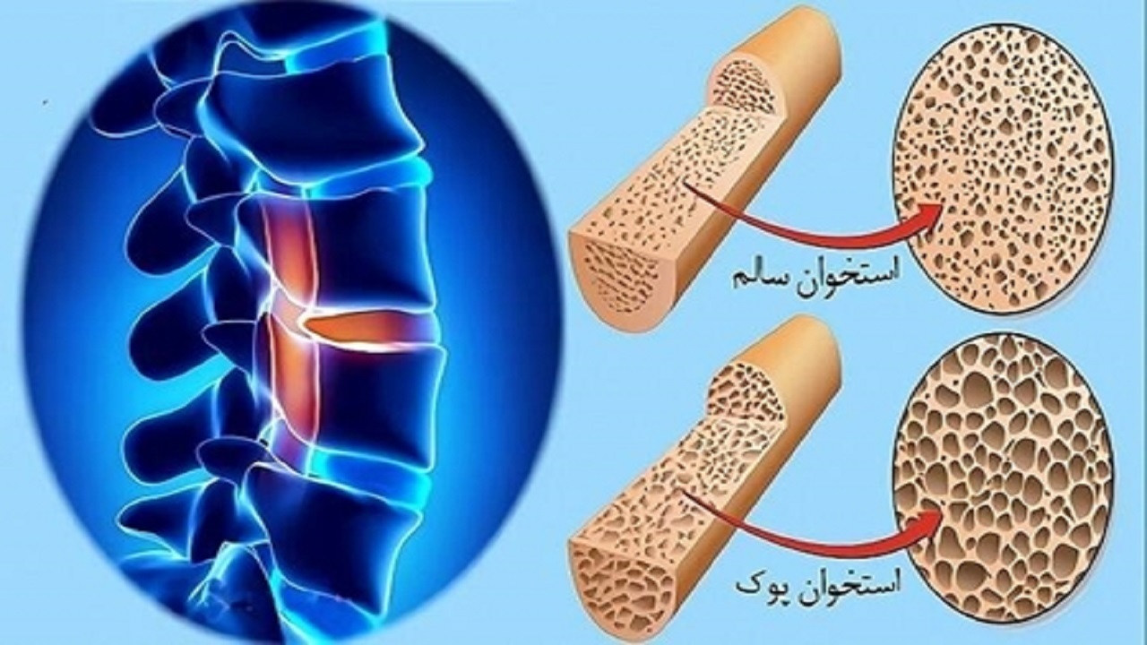 استعمال دخانیات و مصرف کورتون سبب افزیش احتمال ابتلا به پوکی استخوان می&zwnj;شود