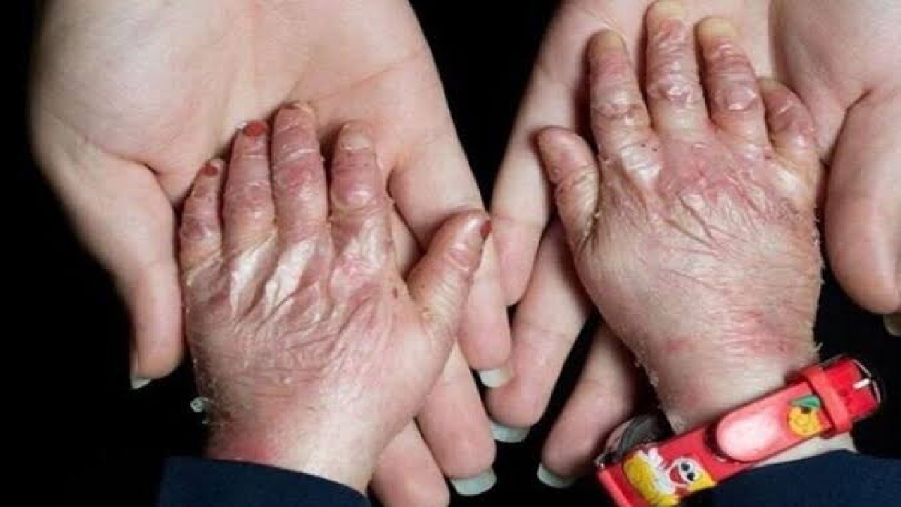 افزایش شناسایی بیماری&zwnj;های نادر به دلیل پیشرفت پزشکی