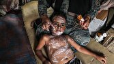 افزایش بیسابقه موارد آبله مرغان در غزه در بحبوحه شرایط دشوار بهداشتی