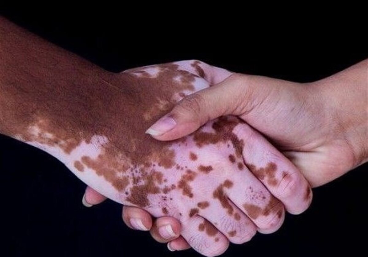 باشگاه خبرنگاران -نتایج امیدوارکننده درمان پیسی با سلول‌های بنیادی در شیراز