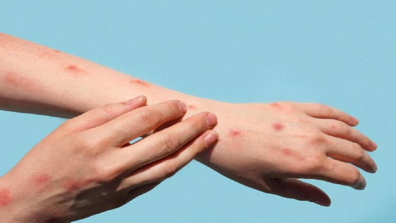 یک علت غیرمنتظره برای زخم&zwnj;های پوستی