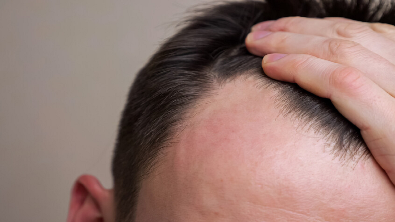 ارتباط برخی از دارو‌های کاهش وزن با ریزش مو