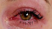 خطرات پنهان اکستنشن مژه برای سلامت چشم
