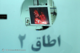 انجام جراحی نادر قلب به روش ویدیویی در بیمارستان مهر مشهد