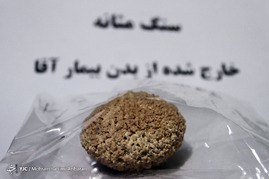 اجسام خارج شده از بدن بیماران در مراکز درمانی-مشهد
