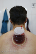 زالو درمانی و طب سنتی